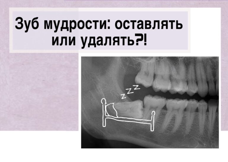 Зуб мудрости: оставить или удалить?